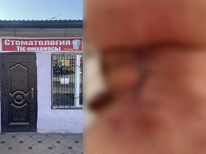Жительница Ленгера столкнулась с тяжёлыми осложнениями после удаления зуба в неизвестной стоматологии
