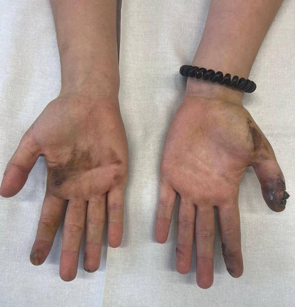 15-летняя девушка попала в больницу после того, как у нее в руках взорвался телефон.