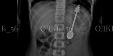 Ребёнок проглотил ложку длиной 14 сантиметров